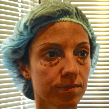 Patient before a mini-blepharoplasty